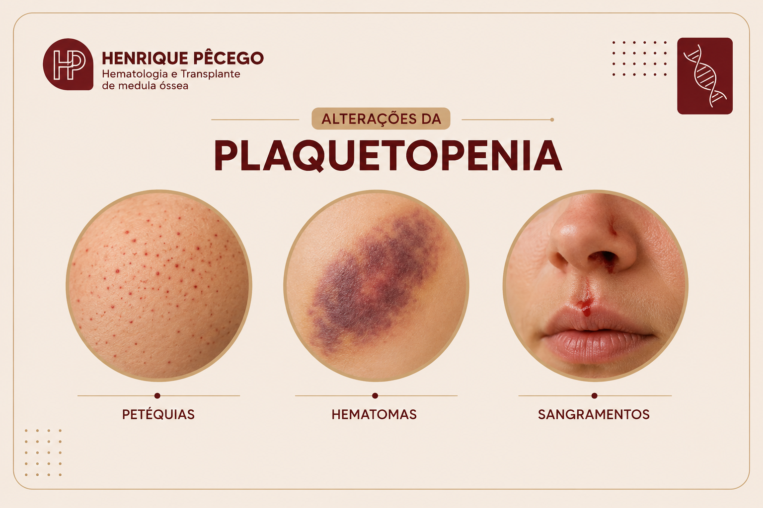 Sinais na pele da plaquetopenia (plaquetas baixas): petéquias, hematomas e sangramento no nariz
