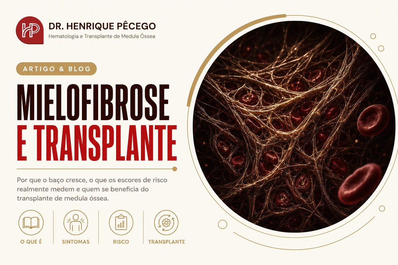 Mielofibrose: sintomas, diagnóstico e tratamento