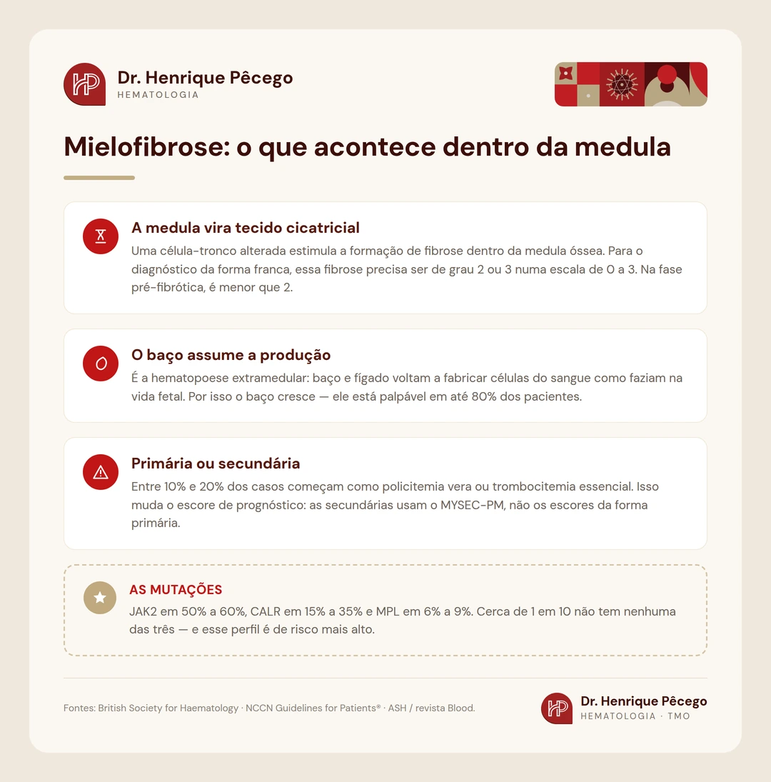 Infográfico: o que acontece na medula na mielofibrose, a hematopoese extramedular e as frequências de JAK2, CALR e MPL