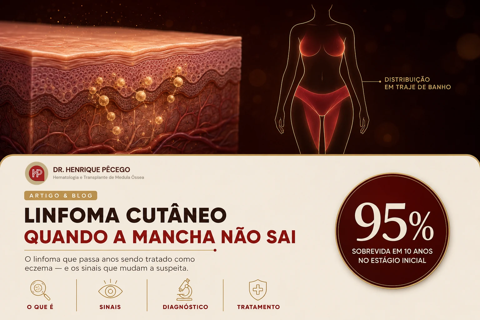 Linfoma cutâneo: tipos, sintomas e diagnóstico