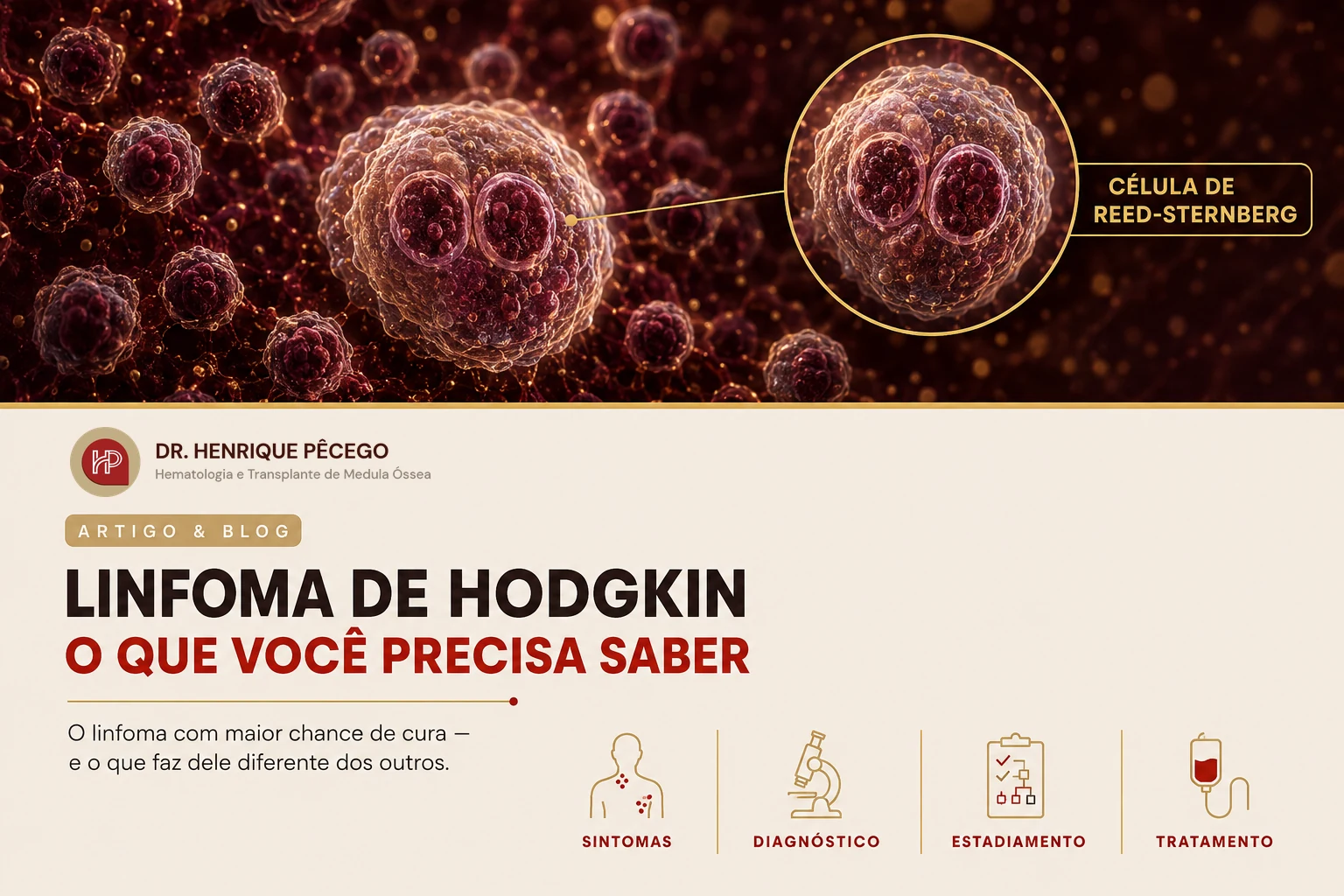 Linfoma de Hodgkin: o que é, sintomas, diagnóstico e tratamento