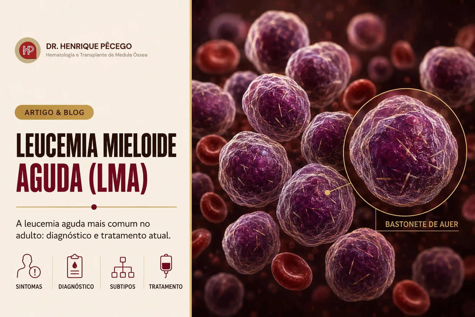 Leucemia mieloide aguda (LMA): o que é, sintomas, diagnóstico e tratamento