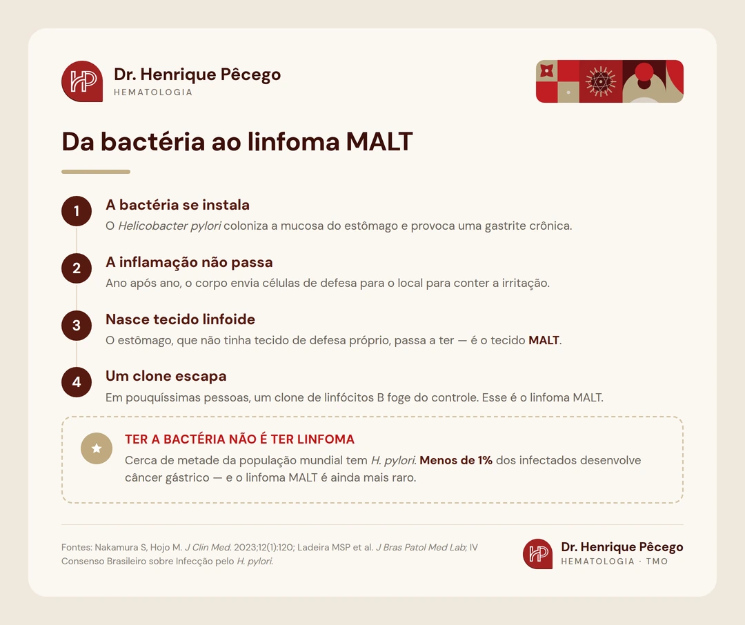 Sequência em quatro passos mostrando como a infecção crônica por Helicobacter pylori leva à formação de tecido linfoide no estômago e, raramente, ao linfoma MALT gástrico