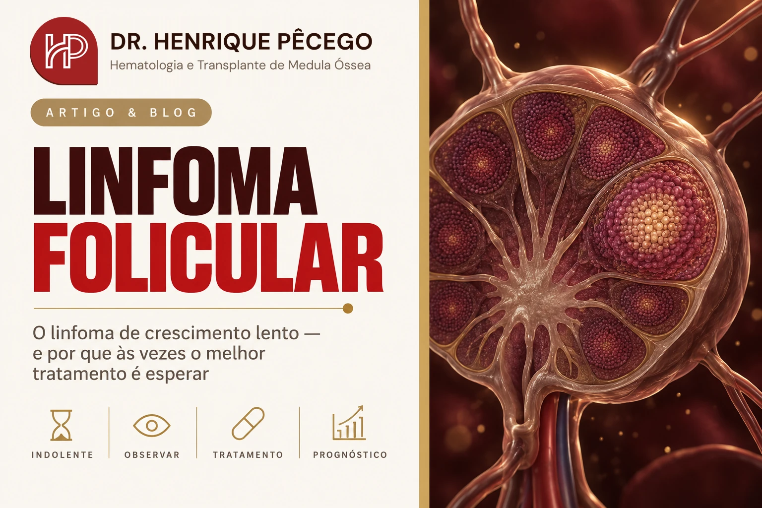 Linfoma folicular: sintomas, prognóstico e tratamento